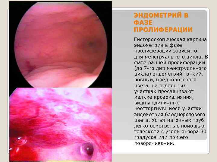 ЭНДОМЕТРИЙ В ФАЗЕ ПРОЛИФЕРАЦИИ Гистероскопическая картина эндометрия в фазе пролиферации зависит от дня менструального