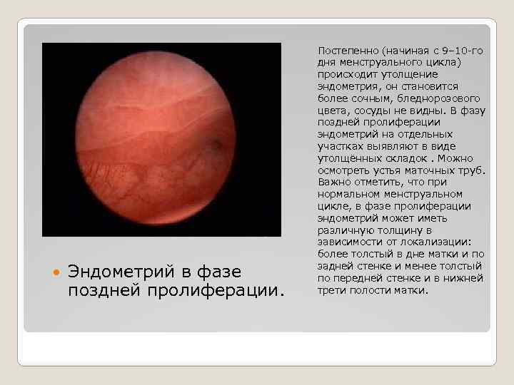  Эндометрий в фазе поздней пролиферации. Постепенно (начиная с 9– 10 -го дня менструального