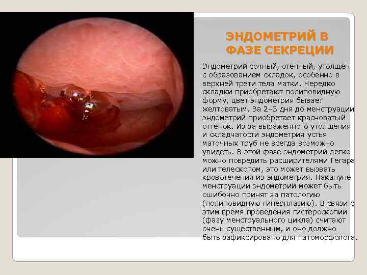 ЭНДОМЕТРИЙ В ФАЗЕ СЕКРЕЦИИ Эндометрий сочный, отёчный, утолщён с образованием складок, особенно в верхней