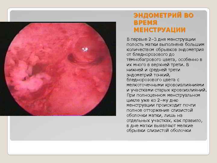 ЭНДОМЕТРИЙ ВО ВРЕМЯ МЕНСТРУАЦИИ В первые 2– 3 дня менструации полость матки выполнена большим
