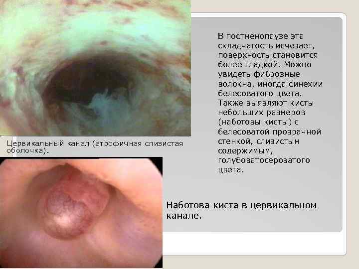 Цервикальный канал (атрофичная слизистая оболочка). В постменопаузе эта складчатость исчезает, поверхность становится более гладкой.