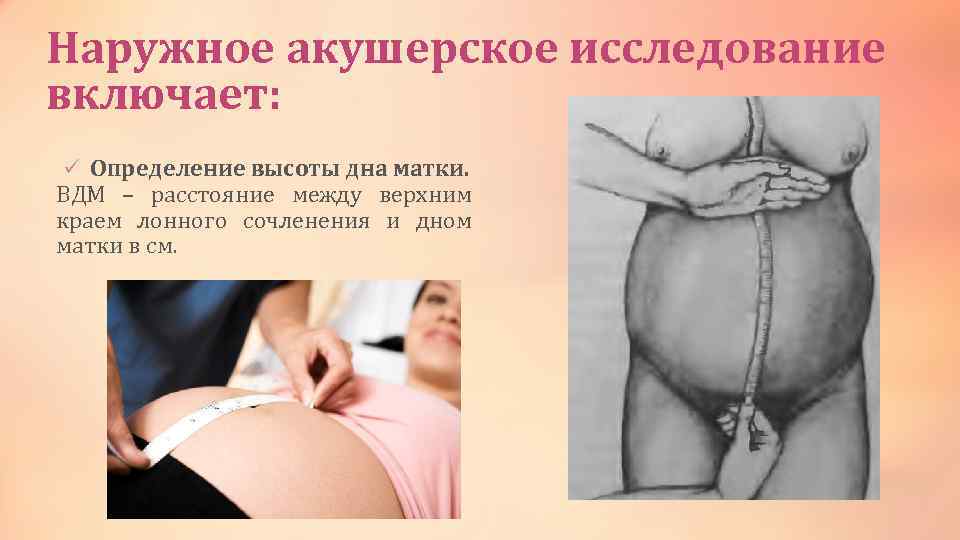 Наружное акушерское исследование включает: ü Определение высоты дна матки. ВДМ – расстояние между верхним