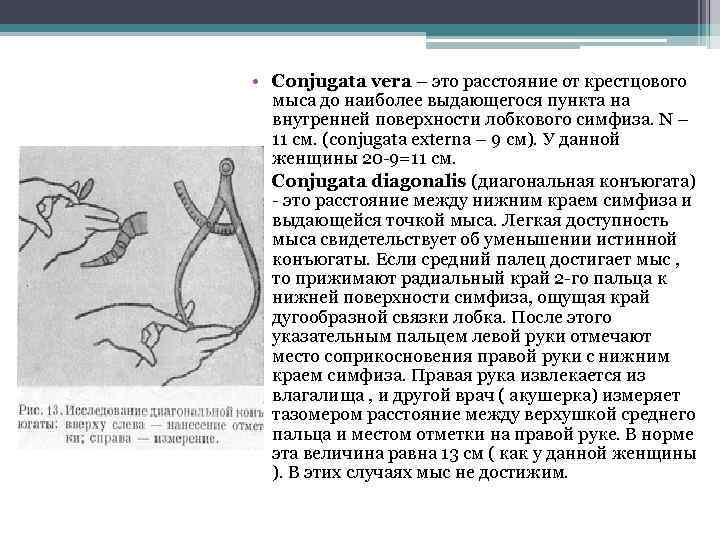 Истинная конъюгата. Истинная конъюгата Вера Акушерство. Конъюгата Вера измерение. Истинная акушерская конъюгата. Измерение диагональной и истинной конъюгаты.