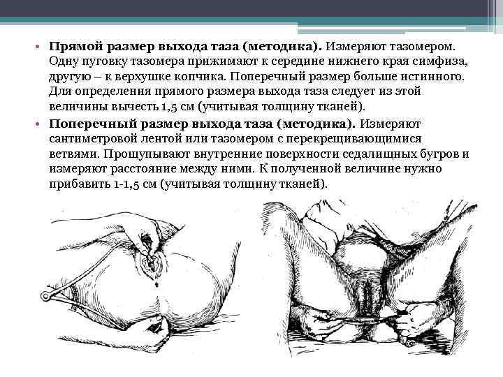  • Прямой размер выхода таза (методика). Измеряют тазомером. Одну пуговку тазомера прижимают к