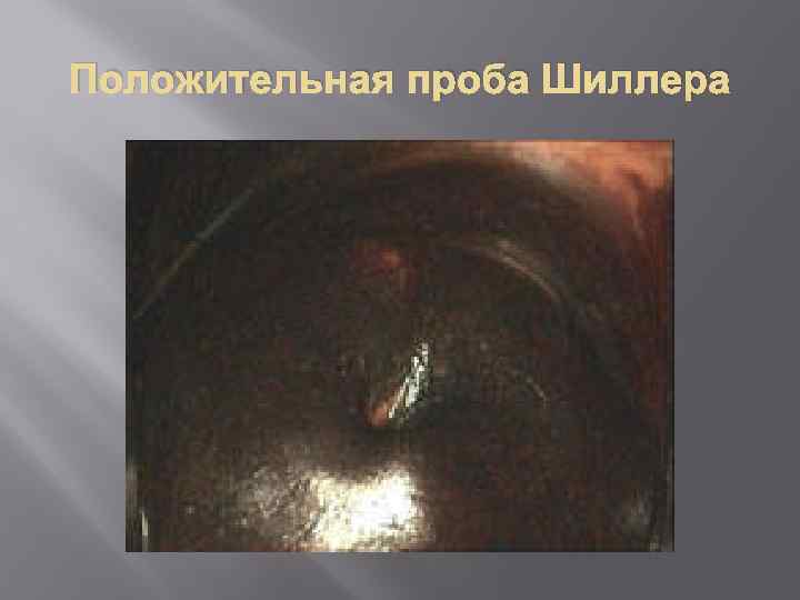 Положительная проба Шиллера 