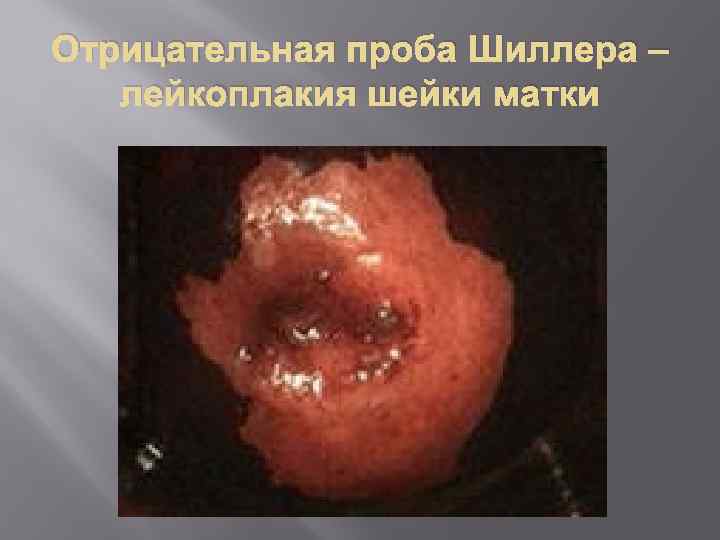 Отрицательная проба Шиллера – лейкоплакия шейки матки 