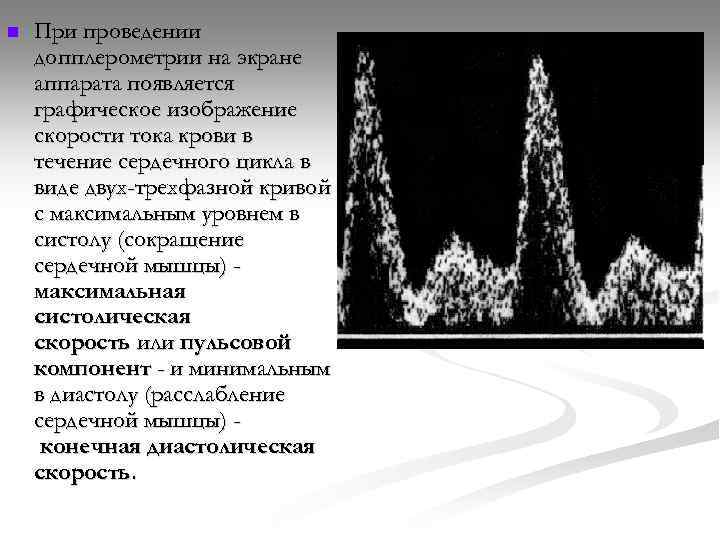 n При проведении допплерометрии на экране аппарата появляется графическое изображение скорости тока крови в
