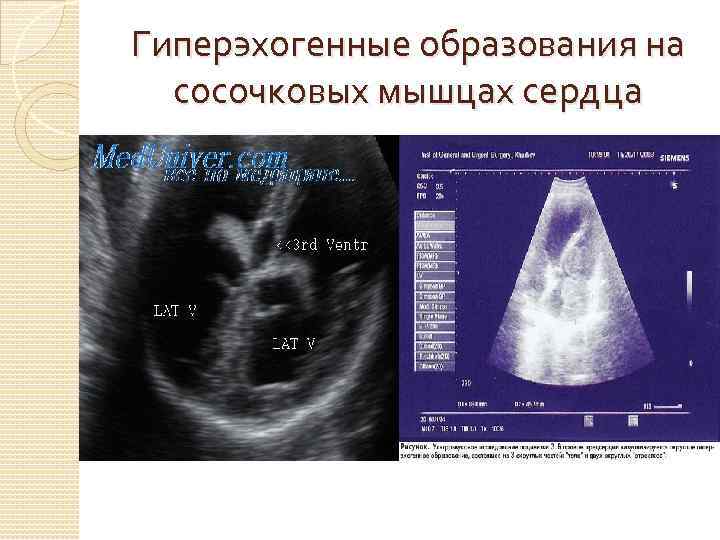 Гиперэхогенные образования на сосочковых мышцах сердца 