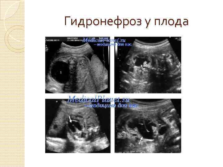 Гидронефроз у плода 
