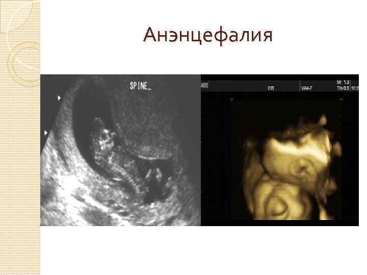 Анэнцефалия 