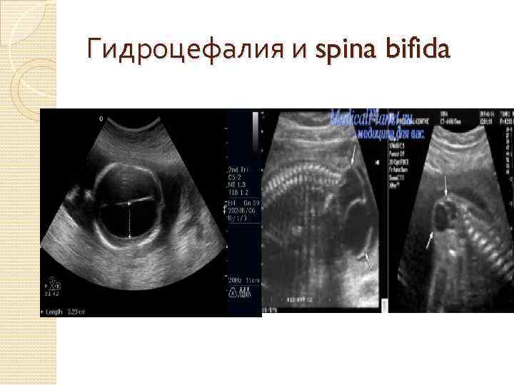 Гидроцефалия и spina bifida 