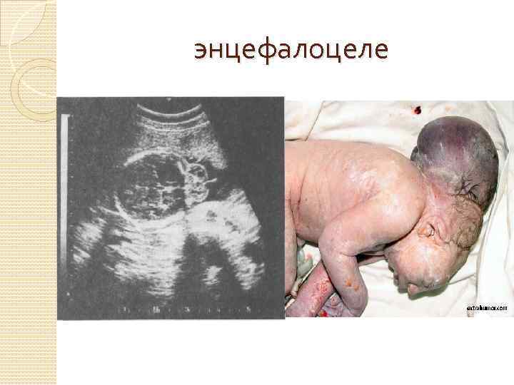 энцефалоцеле 