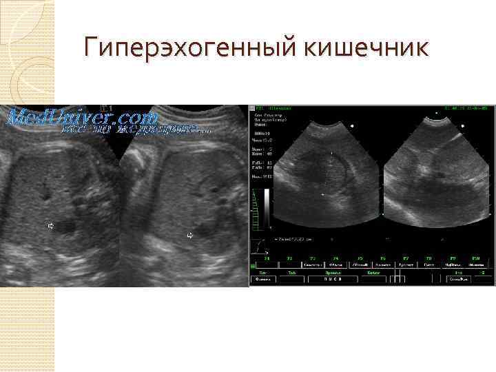 Гиперэхогенный кишечник 