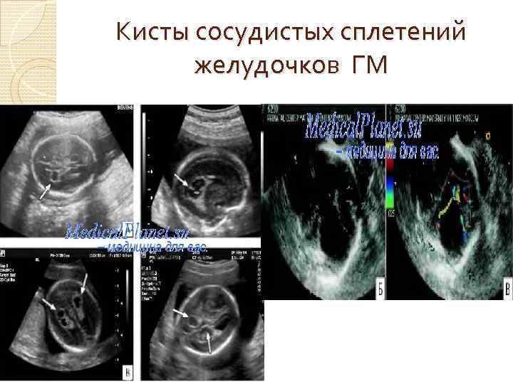 Кисты сосудистых сплетений желудочков ГМ 