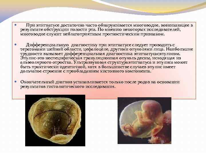  При эпигнатусе достаточно часто обнаруживается многоводие, возникающее в результате обструкции полости рта. По