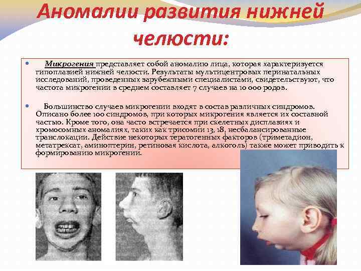 Аномалии развития нижней челюсти: Микрогения представляет собой аномалию лица, которая характеризуется гипоплазией нижней челюсти.
