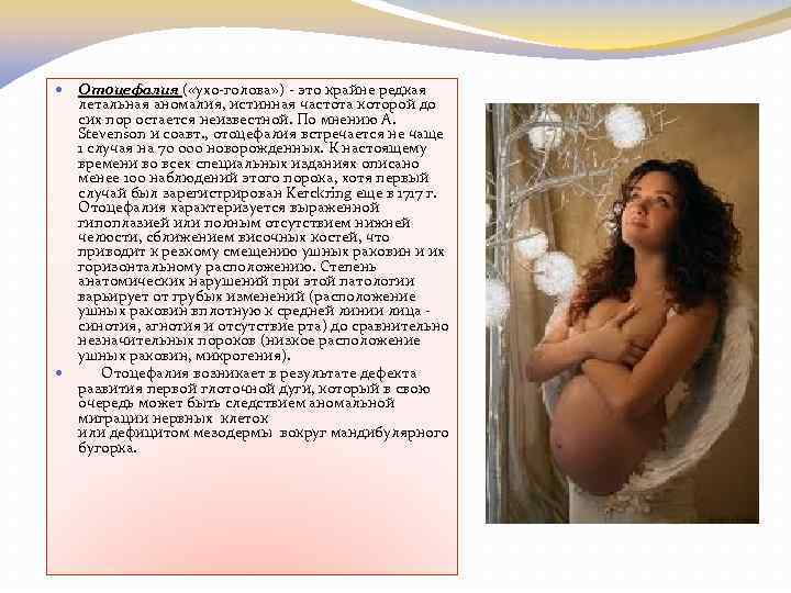 Отоцефалия ( «ухо-голова» ) - это крайне редкая летальная аномалия, истинная частота которой до