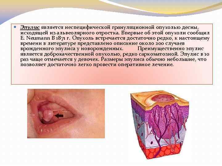  Эпулис является неспецифической грануляционной опухолью десны, исходящей из альвеолярного отростка. Впервые об этой