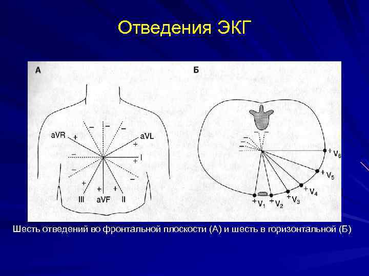 Экг отведения картинка