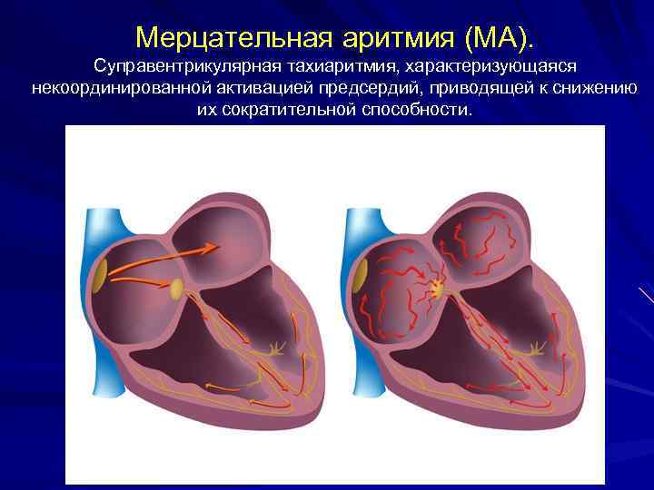 Мерцательная аритмия (МА). Суправентрикулярная тахиаритмия, характеризующаяся некоординированной активацией предсердий, приводящей к снижению их сократительной