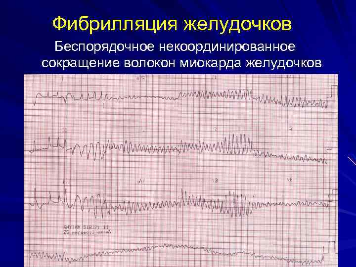 Фибрилляция желудочков Беспорядочное некоординированное сокращение волокон миокарда желудочков 