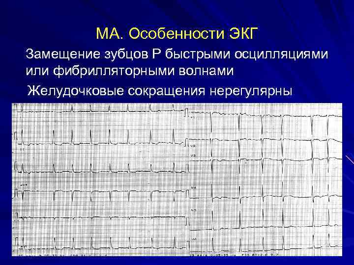 МА. Особенности ЭКГ Замещение зубцов Р быстрыми осцилляциями или фибрилляторными волнами Желудочковые сокращения нерегулярны