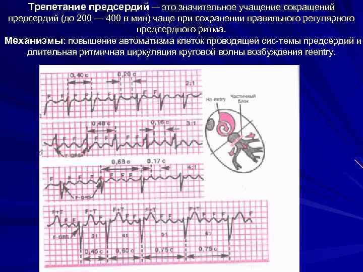 Трепетание предсердий — это значительное учащение сокращений предсердий (до 200 — 400 в мин)