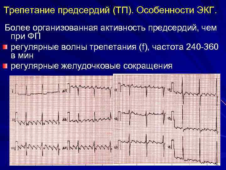 Трепетание предсердий (ТП). Особенности ЭКГ. Более организованная активность предсердий, чем при ФП регулярные волны