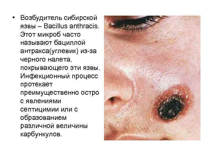  • Возбудитель сибирской язвы – Bacillus anthracis. Этот микроб часто называют бациллой антракса(углевик)