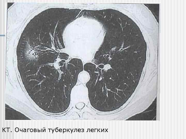 Картина кт при туберкулезе