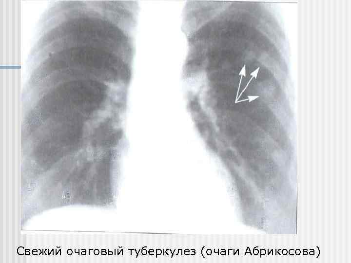 Фазы очагового туберкулеза