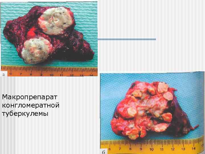 Макропрепарат конгломератной туберкулемы 