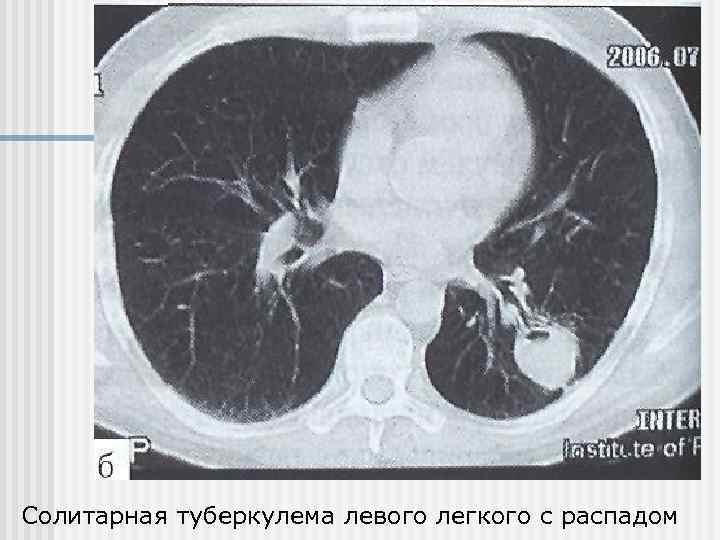 Солитарная туберкулема левого легкого с распадом 