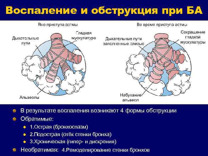 Воспаление и обструкция при БА В результате воспаления возникают 4 формы обструкции Обратимые: l
