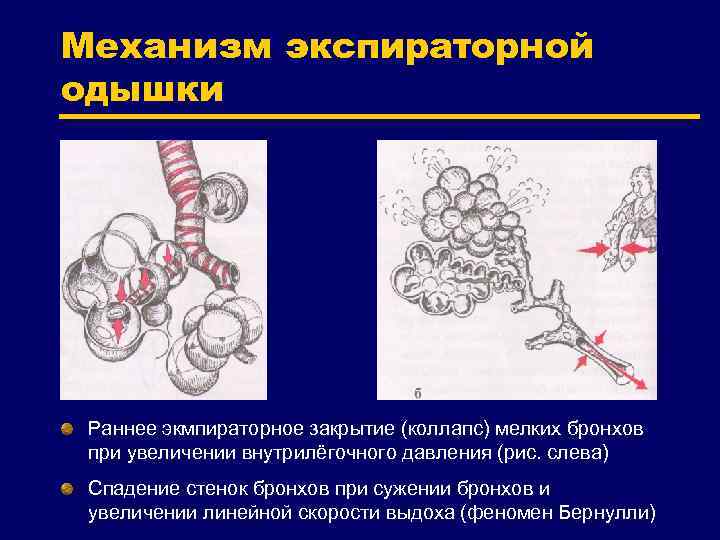 Механизм экспираторной одышки Раннее экмпираторное закрытие (коллапс) мелких бронхов при увеличении внутрилёгочного давления (рис.