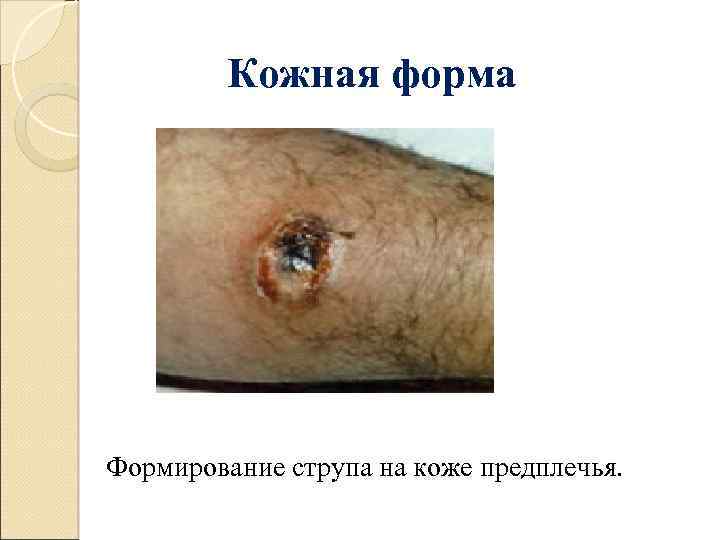 Кожная форма Формирование струпа на коже предплечья. 