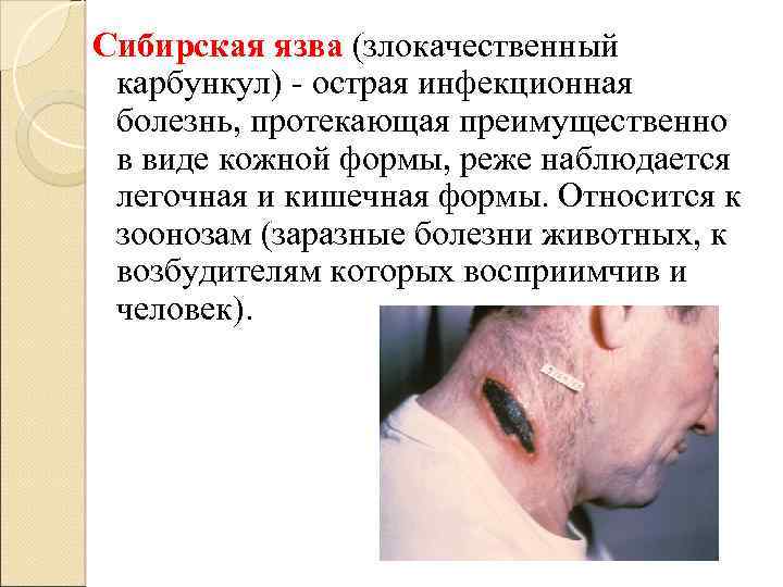 Сибирская язва (злокачественный карбункул) - острая инфекционная болезнь, протекающая преимущественно в виде кожной формы,