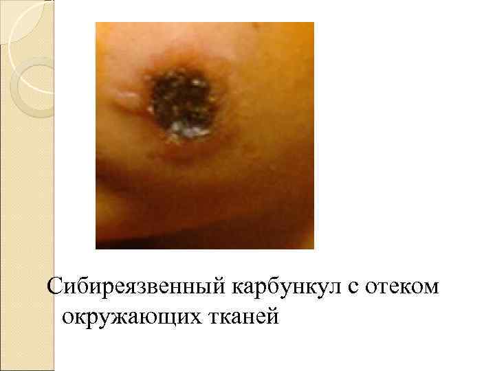 Сибиреязвенный карбункул с отеком окружающих тканей 