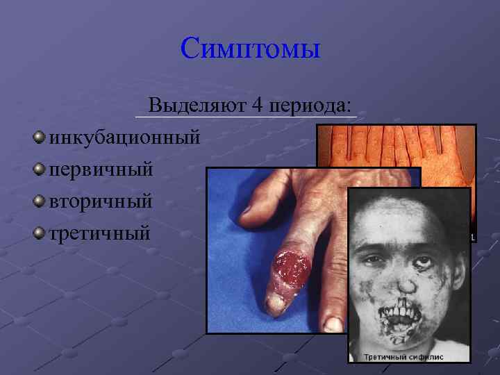 Симптомы Выделяют 4 периода: инкубационный первичный вторичный третичный 