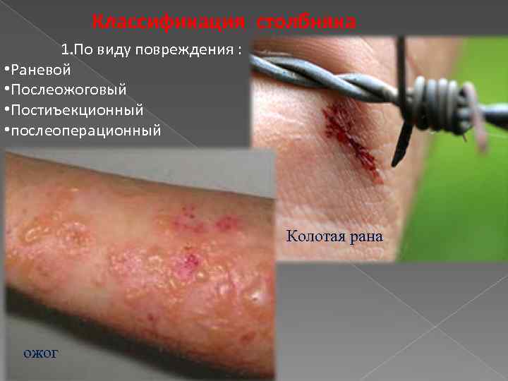 Классификация столбняка 1. По виду повреждения : • Раневой • Послеожоговый • Постиъекционный •