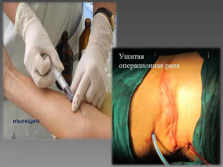 Ушитая операционная рана иъекция 