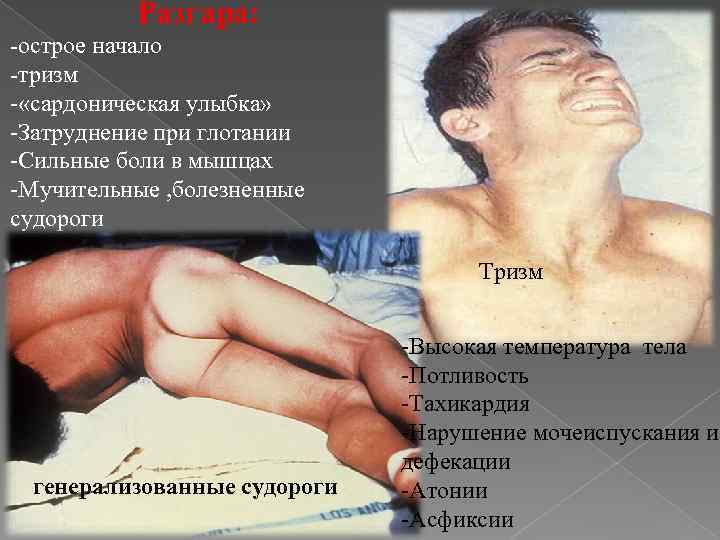 Разгара: -острое начало -тризм - «сардоническая улыбка» -Затруднение при глотании -Сильные боли в мышцах