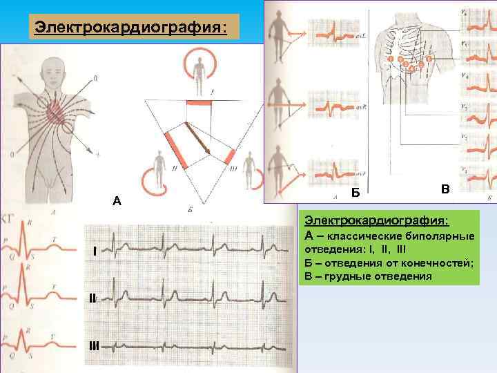 Стенки на экг