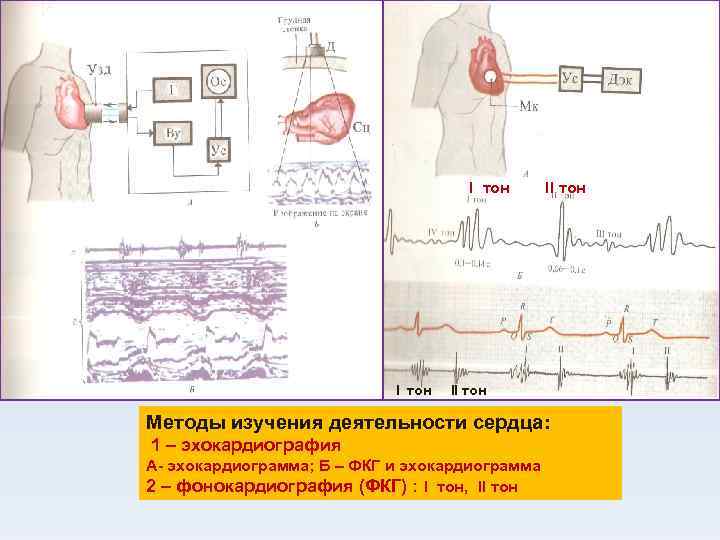 I тон II тон Методы изучения деятельности сердца: 1 – эхокардиография А- эхокардиограмма; Б