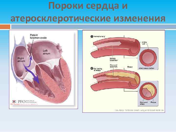 Пороки сердца и атеросклеротические изменения 