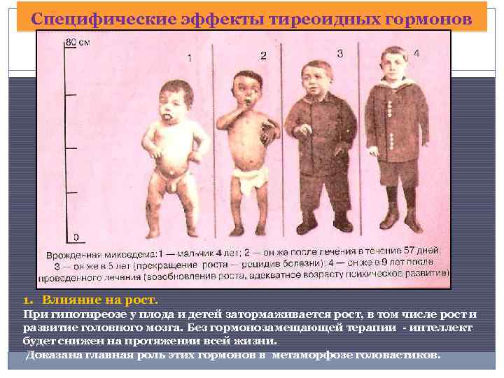 Специфические эффекты тиреоидных гормонов 1. Влияние на рост. При гипотиреозе у плода и детей