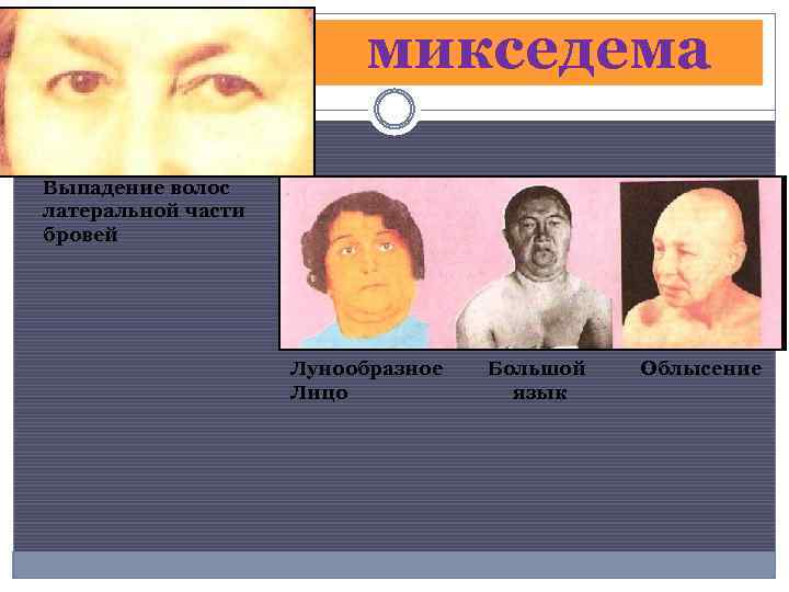микседема Выпадение волос латеральной части бровей Лунообразное Лицо Большой язык Облысение 