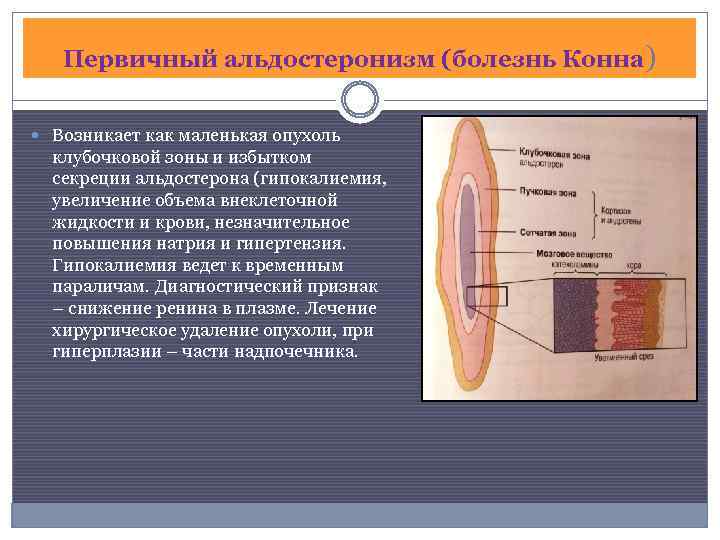 Первичный альдостеронизм (болезнь Конна) Возникает как маленькая опухоль клубочковой зоны и избытком секреции альдостерона