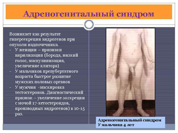 Адреногенитальный синдром Возникает как результат гиперсекреции андрогенов при опухоли надпочечника. - У женщин –