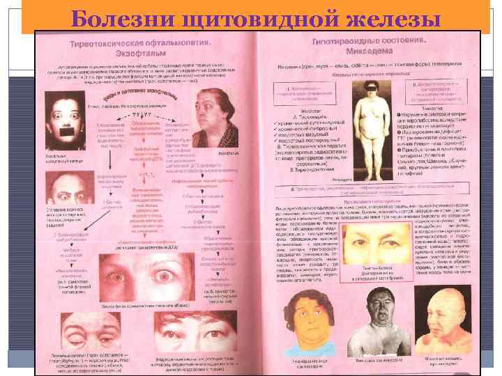 Болезни щитовидной железы 